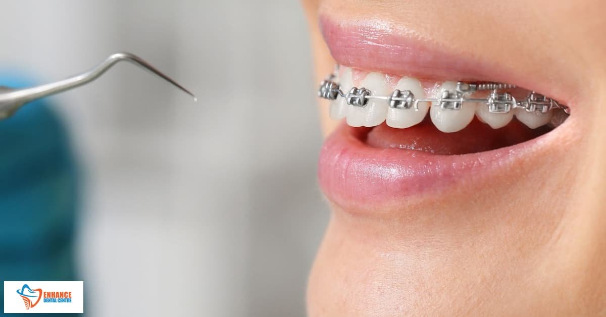 All You Need to Know about Orthodontic Retainers Enhance Dental CA