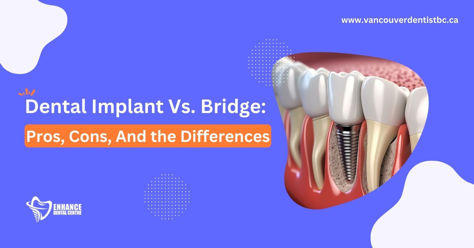 Dental Implant Vs. Bridge Pros, Cons, And the Differences Enhance