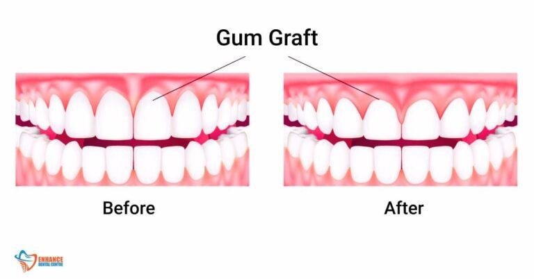 a-guide-to-gum-grafting-before-after-photos-enhance-dental-care