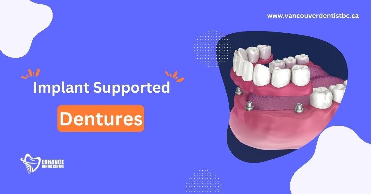 Implant Supported Dentures Enhance Dental Care